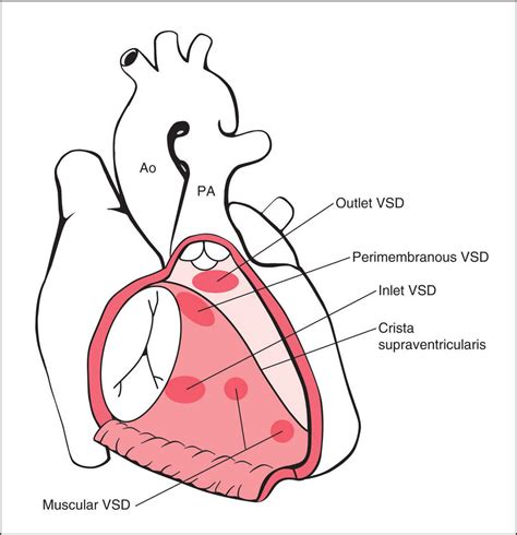 Ventricular Septal Defect Anatomy