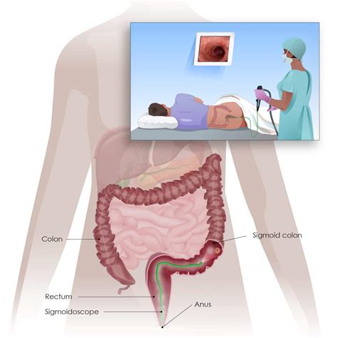 Colorectal Cancer - Screening and testing - Digestive Cancers Europe