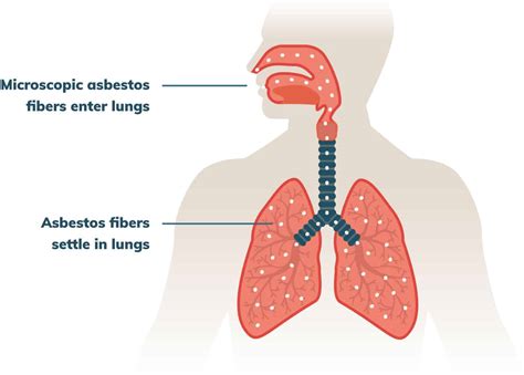 Mesothelioma Pictures | Mesothelioma.com