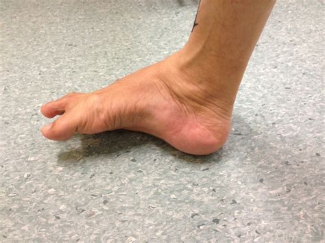 Foot Deformity Singapore | Surgery Reconstruction | Treatment