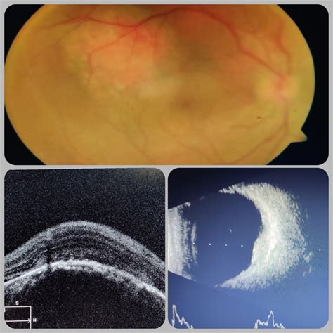 Circumscribed Choroidal Hemangioma - Retina Image Bank