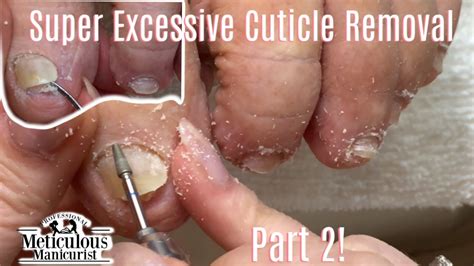 Excessive Cuticle Removal Galore Diabetic Pedicure Tutorial Part 2 ...