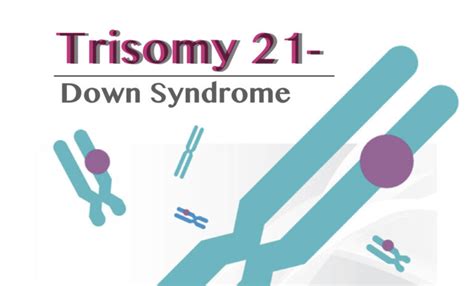 Trisomy 21 (Down Syndrome): Definition, Causes, Symptoms, Pictures and ...