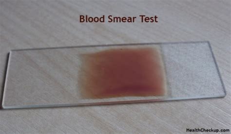 Peripheral Blood Smear Test Purpose, Procedure, Results & Interpretation