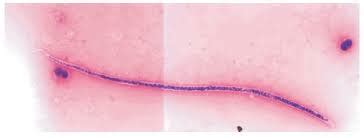 loiasis disease