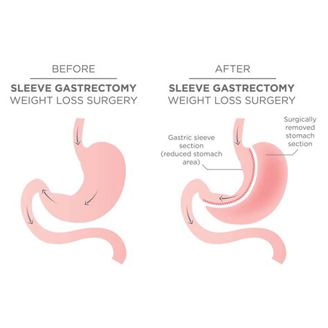 Vertical Gastric Sleeve Surgery Perth | Perth Bariatric Surgery