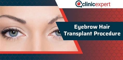 Eyebrow Hair Transplant Procedure | ClinicExpert