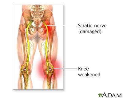 Sciatica Information | Mount Sinai - New York