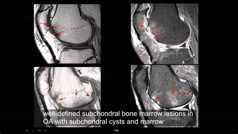 MRI imaging of knee part 2 by Dr. Amr Saadawy - YouTube