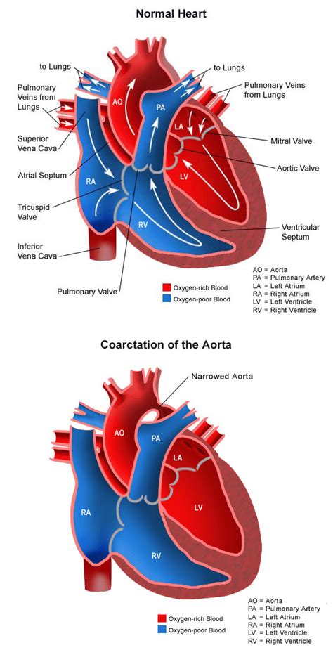 Coarctation of the Aorta - Children's Hospital of Orange County