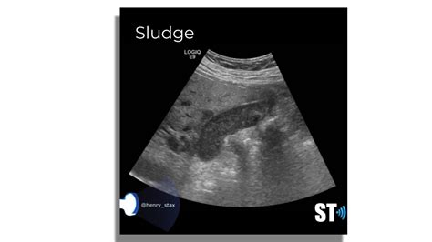 Gallbladder Sludge