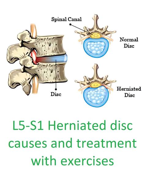 Herniated disk in lower back causes and relief with 3 exercises