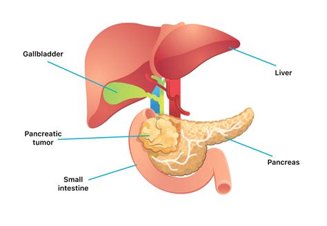 Cancer In Lymph Nodes In Chest Symptoms