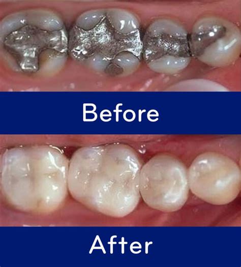 Mercury Amalgam Fillings Compared to Composites