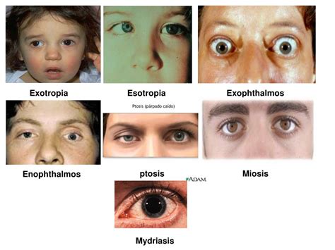 PPT - Eye movement disorder PowerPoint Presentation, free download - ID ...