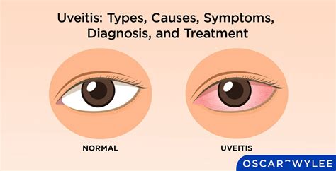 Uveitis: Types, Causes, Symptoms, Diagnosis, and Treatment