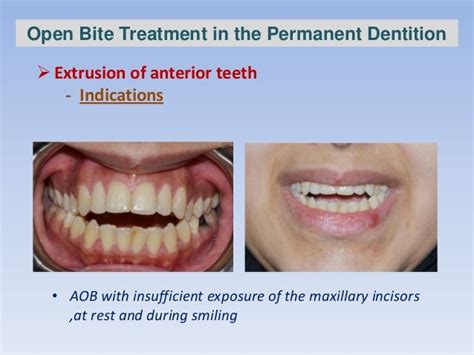 Anterior open bite treatment permanent dentition -1- .slide