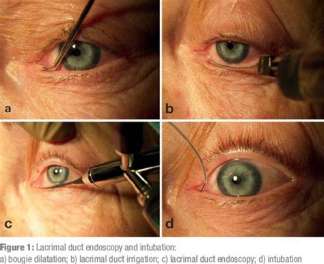 Modern Lacrimal Duct Surgery From the Ophthalmological Perspective (09. ...