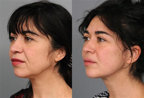 Naturalift™ Mini Facelift Before and After Photo Gallery | New York, NY ...