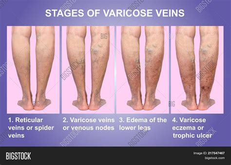 Varicose Veins On Image & Photo (Free Trial) | Bigstock