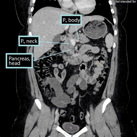 Pancreas Us Anatomy