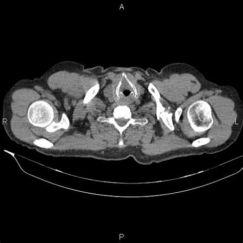 Bochdalek hernia (Radiopaedia 63097-71597 Axial non-contrast) - NC Commons