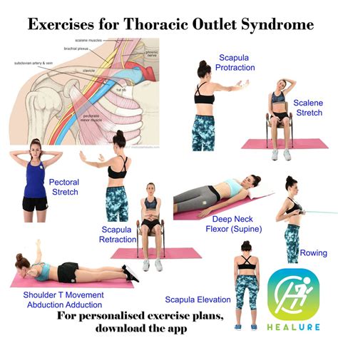 Thoracic Outlet Syndrome Exercises