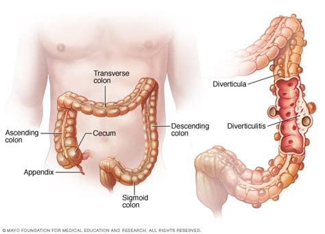 Diverticulosis and diverticulitis - Mayo Clinic