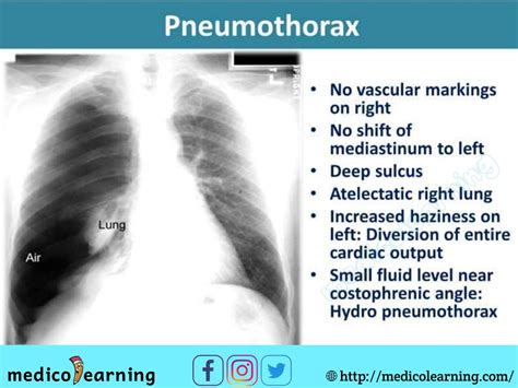 chest x ray interpretation - Wendy Rutherford