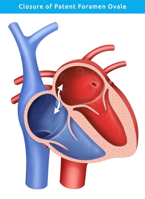 Closure of Patent Foramen Ovale | Professor Kevin P Walsh