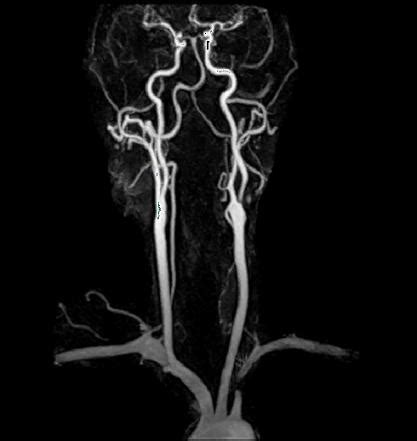 MR Angiography | Cedars-Sinai