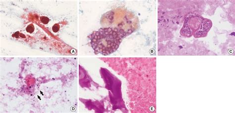 Cytologic findings. (A) There are many protoscolices in the shape of a ...