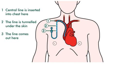 这个Venous pressure line怎么翻译？