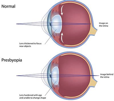 Accommodation For the Aging Eye