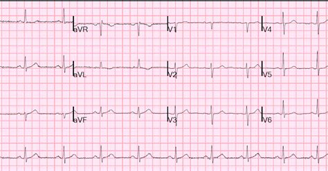 Dr. Smith's ECG Blog: A Case of Clinical Unstable Angina in the ED