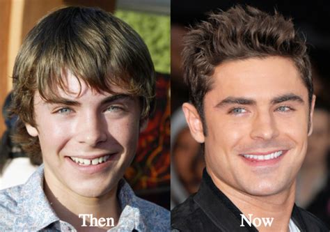 Zac Efron Plastic Surgery Before and After Photos