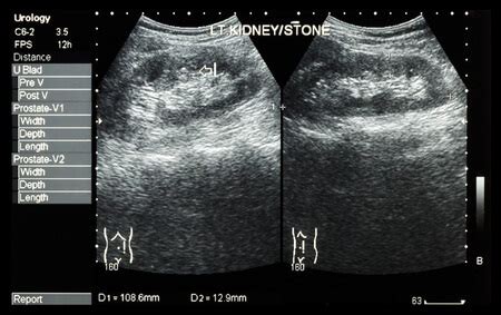 Kidney Stones Ultrasound