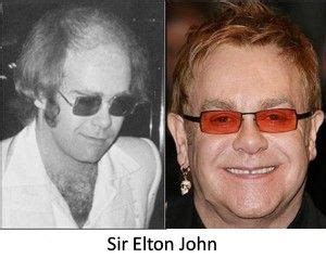 Did Elton John have a hair transplant? | Hair transplant, Celebrity ...