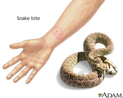 Snake bites Information | Mount Sinai - New York