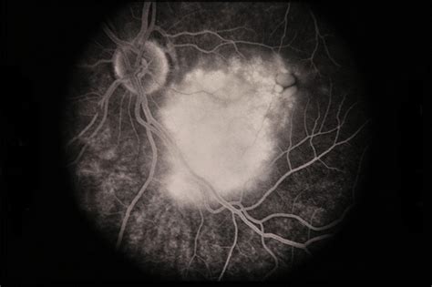 Choroidal Hemangioma - Retina Image Bank