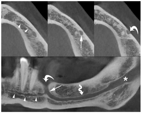 Mandibular Canal