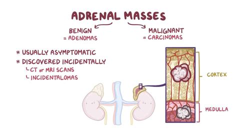 Adrenal masses and tumors: Clinical: Video & Anatomy | Osmosis