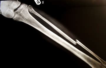 medical - Where to find fracture xray imaging data? - Open Data Stack ...