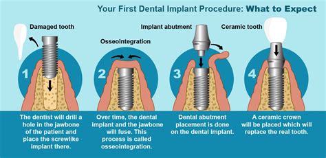 What is a Dental Implant? | Best Dental Clinic in Lucknow