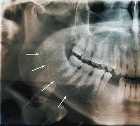 Mandibular canal and salivary gland stones, X-ray - Stock Image - C040 ...