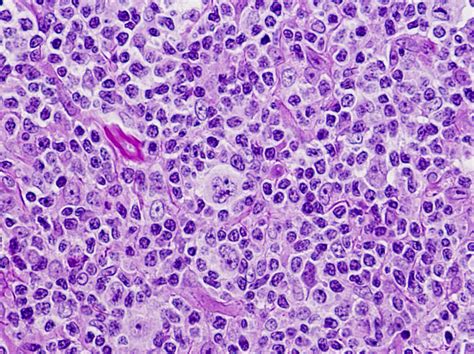 Hodgkin Lymphoma Pathology Outlines