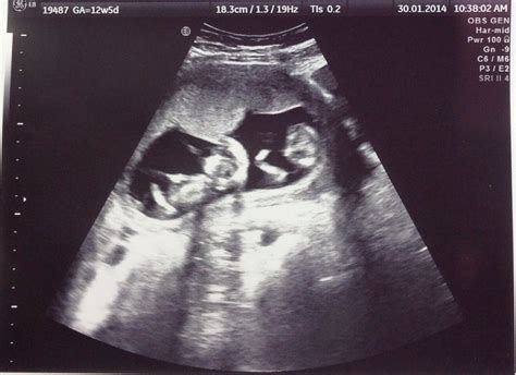 Fraternal Twins, 12 week ultrasound 12 Week Ultrasound, Baby Ultrasound ...