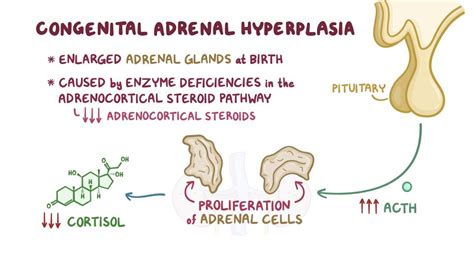 Congenital adrenal hyperplasia: Clinical (To be retired) | Osmosis