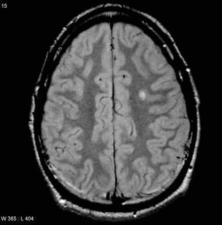 Ganglioglioma | Image | Radiopaedia.org