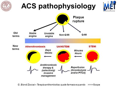 Unstable Angina Nstemi Stemi